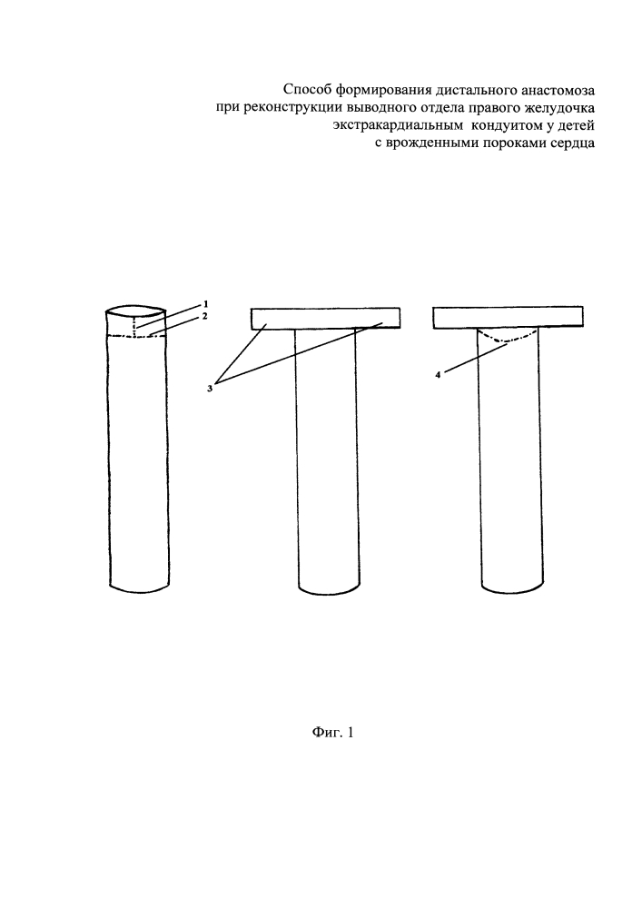 Способ формирования дистального анастомоза при реконструкции выводного отдела правого желудочка экстракардиальным кондуитом у детей с врожденными пороками сердца (патент 2644921)