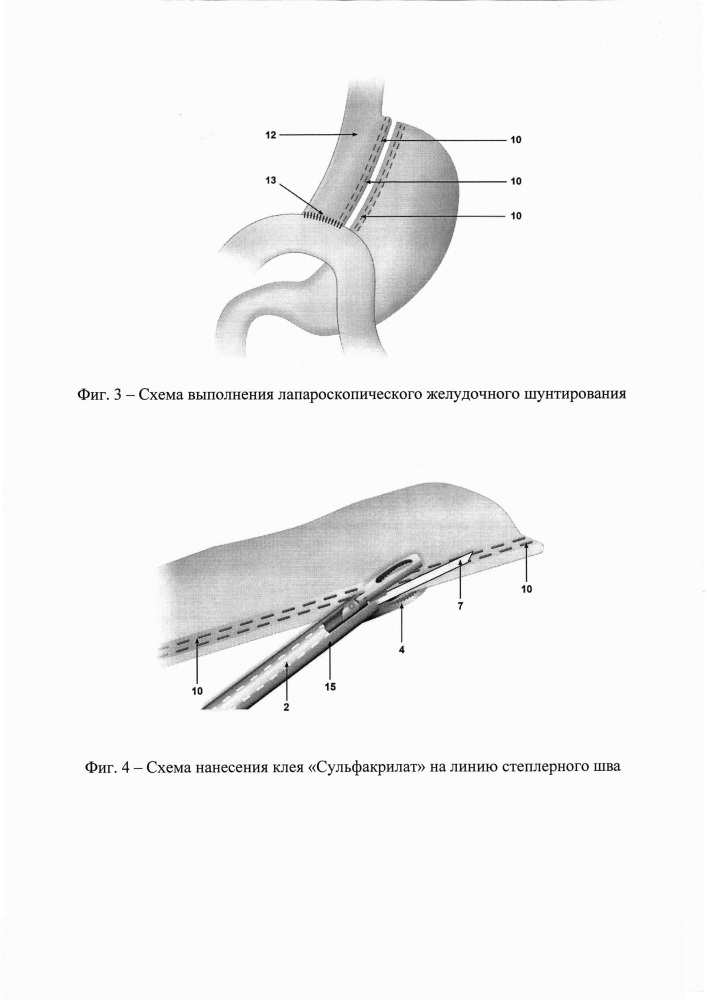 Устройство для доставки клея "сульфакрилат" на линию степлерного шва и способ его использования (патент 2622368)