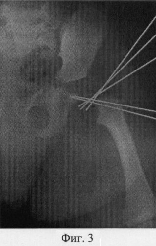 Способ лечения врожденной варусной деформации шейки бедра (патент 2477094)
