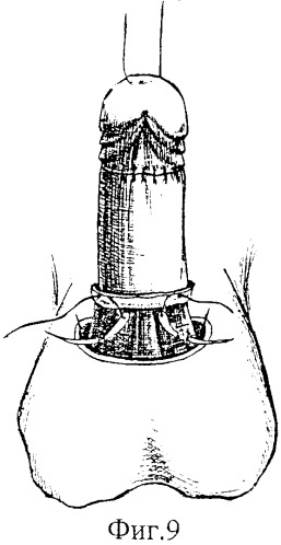 Способ высвобождения кавернозных и спонгиозного тел и удлинения видимой части ствола полового члена (патент 2350284)