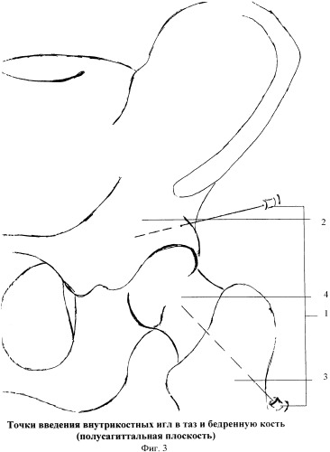 Способ внутрикостного введения лекарственных препаратов при болезни легга-кальве-пертеса (блкп) (патент 2367478)