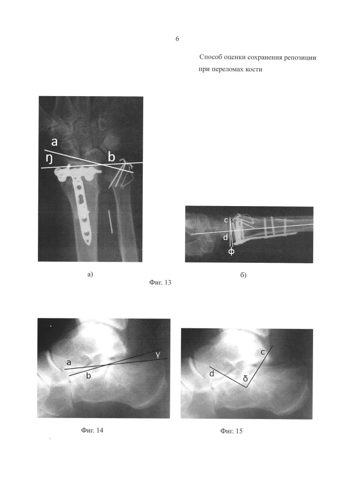 Способ оценки сохранения репозиции переломов костей (патент 2626375)