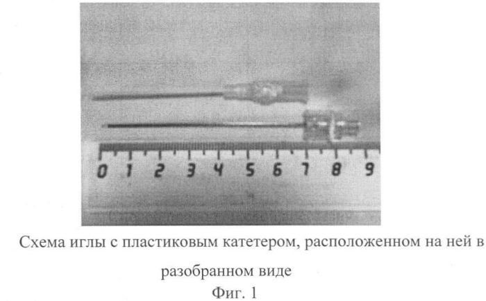 Способ проводниковой анестезии (патент 2426563)