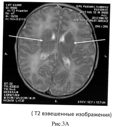 Способ определения зрелости церебральных структур у недоношенных новорожденных (патент 2491888)