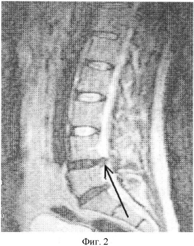 Способ лечения грыж поясничных межпозвонковых дисков (патент 2368401)