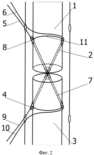 Способ наложения чрескожного погружного шва ахиллова сухожилия (патент 2398543)