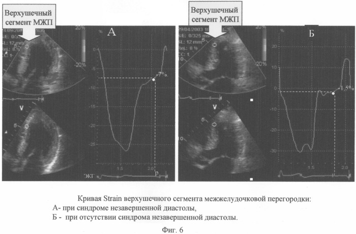 Способ диагностики синдрома незавершенной диастолы у больных с идиопатической гипертрофической кардиомиопатией (патент 2265399)