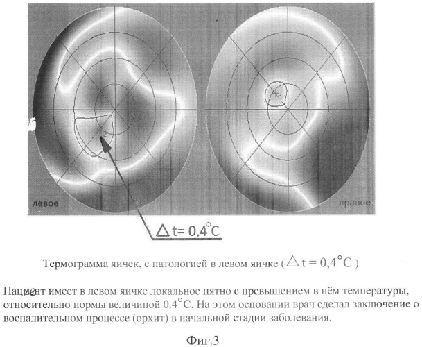 Способ и устройство для ранней экспресс-диагностики патологии яичек (патент 2537764)