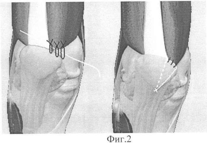 Способ хирургической реинсерции m. vastus medialis obliquus при посттравматической латеральной пателлярной дислокации с использованием артроскопических технологий (патент 2354316)