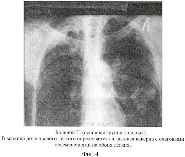 Способ хирургического лечения туберкулеза легких (патент 2417762)