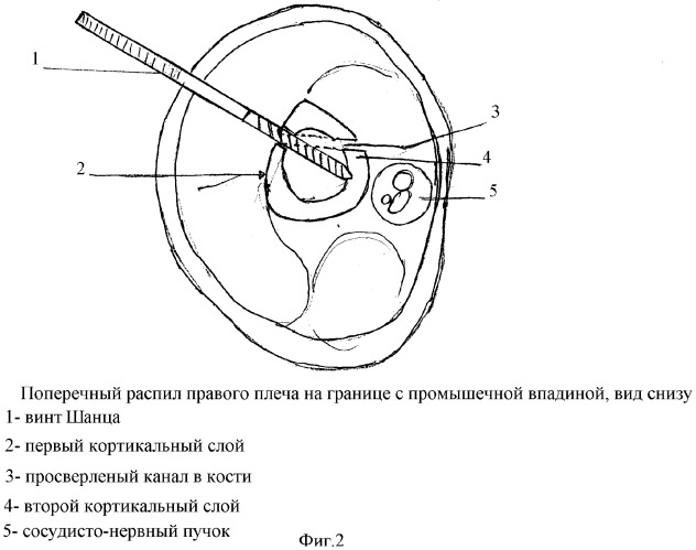 Устройство для формирования канала в кости и установки в него винта шанца (патент 2353322)