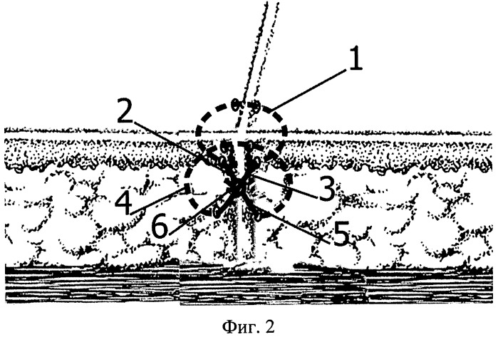 Способ наложения хирургического шва (патент 2436528)