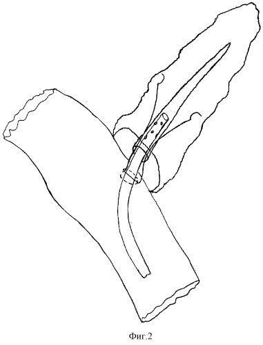 Способ формирования терминолатерального панкреатоеюноанастомоза при панкреатодуоденальной резекции (патент 2293530)