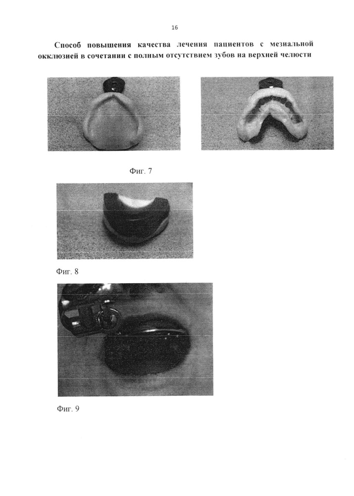 Способ повышения качества лечения пациентов с мезиальной окклюзией в сочетании с полным отсутствием зубов на верхней челюсти (патент 2658159)