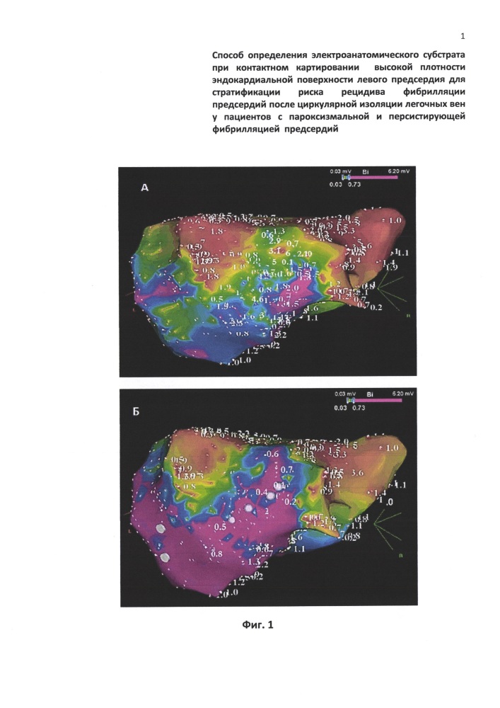 Способ определения электроанатомического субстрата при контактном картировании высокой плотности эндокардиальной поверхности левого предсердия для стратификации риска рецидива фибрилляции предсердий после циркулярной изоляции легочных вен у пациентов с пароксизмальной и персистирующей фибрилляцией предсердий (патент 2649506)