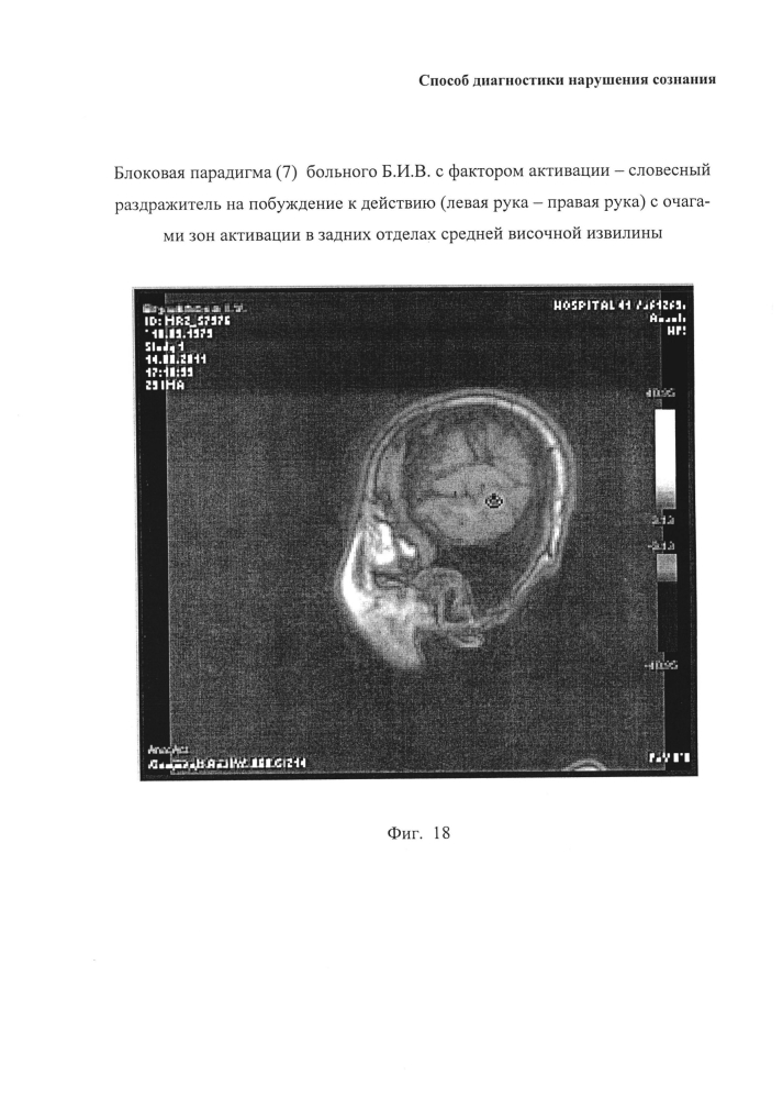 Способ диагностики нарушения сознания (патент 2596049)