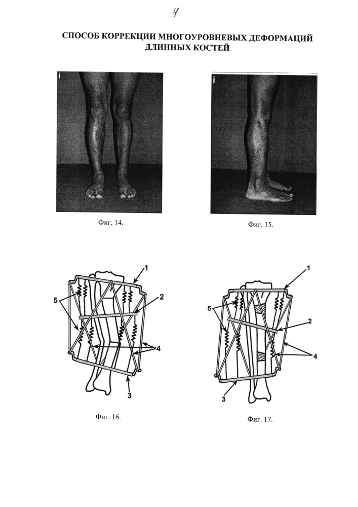 Способ коррекции многоуровневых деформаций длинных костей (патент 2640999)