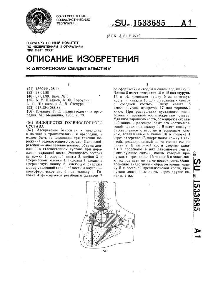 Эндопротез голеностопного сустава (патент 1533685)