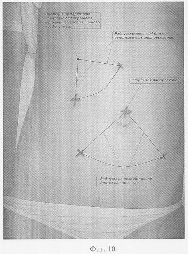 Способ определения мест оптимальной установки манипуляционных троакаров при лапароскопических операциях на органах забрюшинного пространства (патент 2338481)