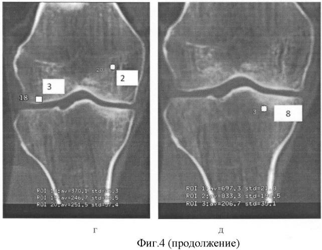 Способ определения степени изменения губчатой кости при деформирующем артрозе коленного сустава (патент 2487669)