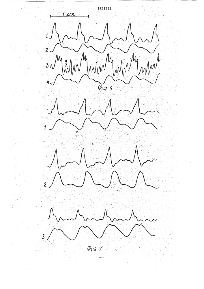 Способ режима гемофильтрации у больных перитонитом (патент 1821222)
