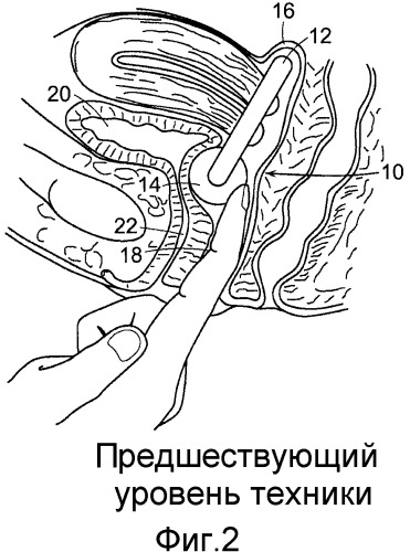 Коррекция стрессового недержания мочи (патент 2548825)