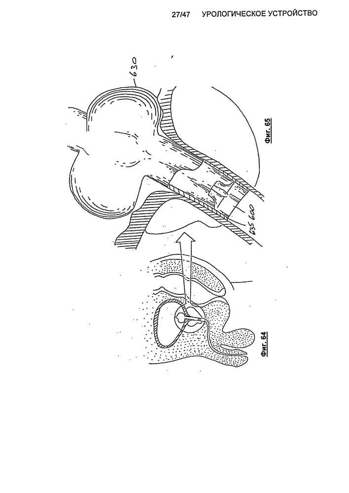 Урологическое устройство (патент 2600865)