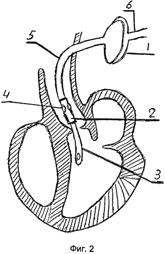 Искусственный желудочек сердца (варианты) (патент 2550047)