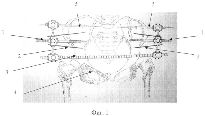 Способ лечения повреждений таза с нарушением целостности переднего и заднего его отделов (патент 2364359)