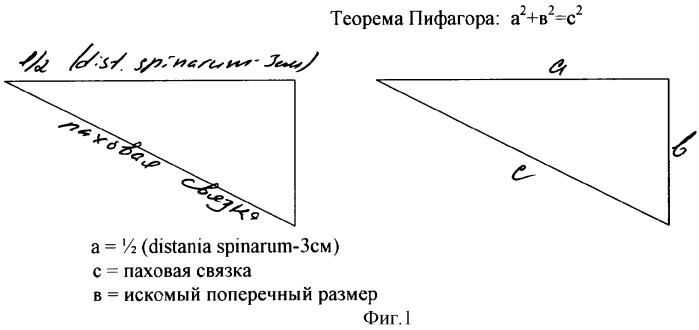 Способ моделирования полипропиленового имплантата, используемого при протезировании передней брюшной стенки у больных с паховыми и бедренными грыжами (патент 2340294)