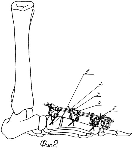 Способ хирургической реабилитации больных с &quot;hallux valgus&quot; (патент 2259174)