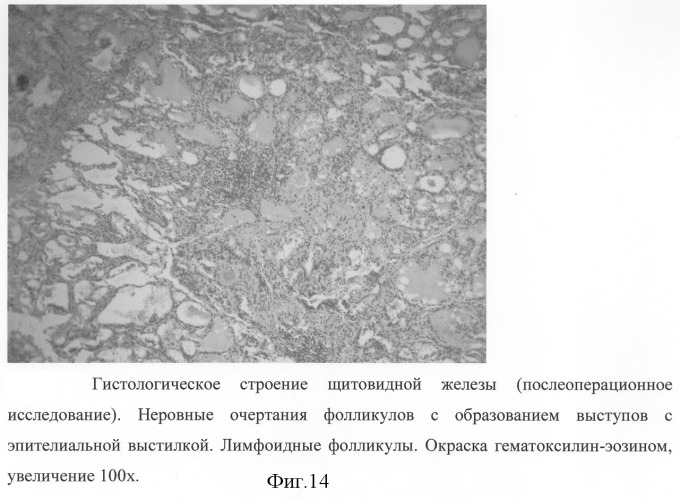 Способ хирургического лечения диффузного токсического зоба (патент 2281040)