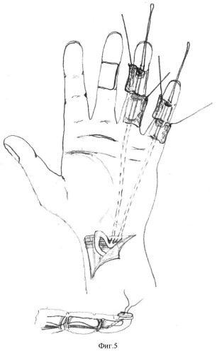 Способ несвободной аутогенной тендопластики глубоких сгибателей пальцев кисти путем транспозиции расщепленного сухожильного трансплантата (патент 2375980)