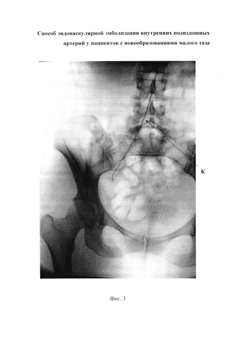 Способ эндоваскулярной эмболизации внутренних подвздошных артерий у пациенток с новообразованиями малого таза (патент 2576092)