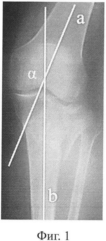 Способ оценки сохранения репозиции переломов костей (патент 2626375)