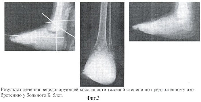 Способ лечения рецидивирующей косолапости тяжелой степени у детей раннего возраста (патент 2370229)