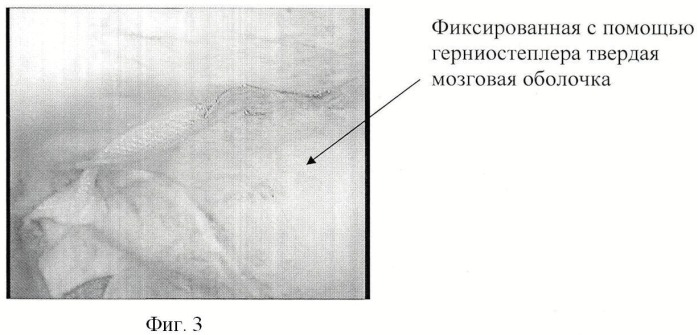 Способ комбинированной лапароскопической герниопластики (патент 2435528)