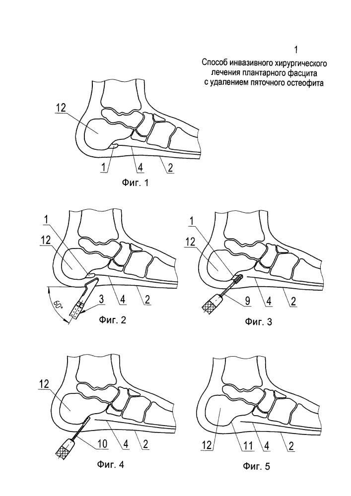 Способ инвазивного хирургического лечения плантарного фасцита с удалением пяточного остеофита (патент 2619580)