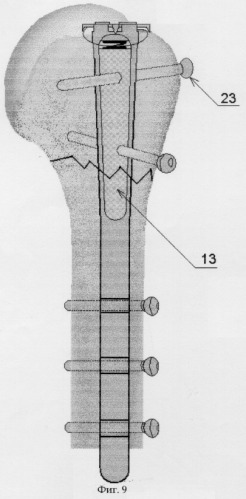 Устройство для интрамедуллярного остеосинтеза переломов проксимального отдела плечевой кости (патент 2283631)