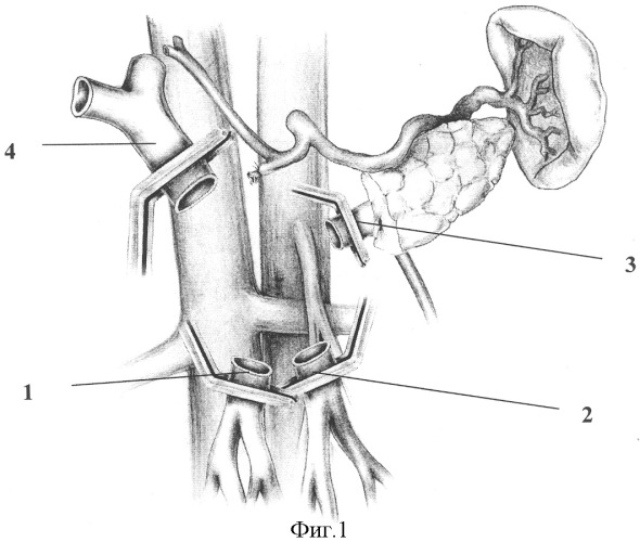 Способ панкреатодуоденальной резекции при местнораспространенном раке периампулярной области с обширной опухолевой инвазией магистральных вен мезентерико-портальной системы и наличием двух основных стволов верхней брыжеечной вены (патент 2317018)