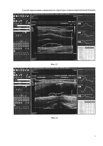 Способ определения однородности структуры атеросклеротической бляшки (патент 2584135)