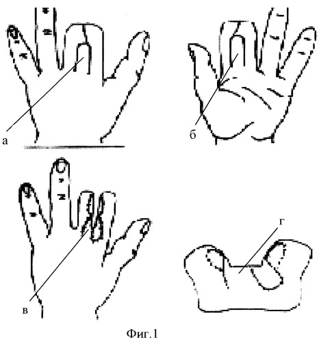 Способ подготовки кисти к протезированию при наличии синдактилии пальцев (патент 2393777)
