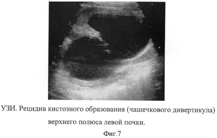 Способ дифференциальной диагностики чашечковых дивертикулов и солитарных кист почек у детей (патент 2411910)