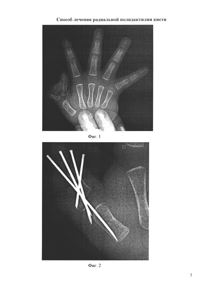 Способ лечения радиальной полидактилии кисти (патент 2612190)