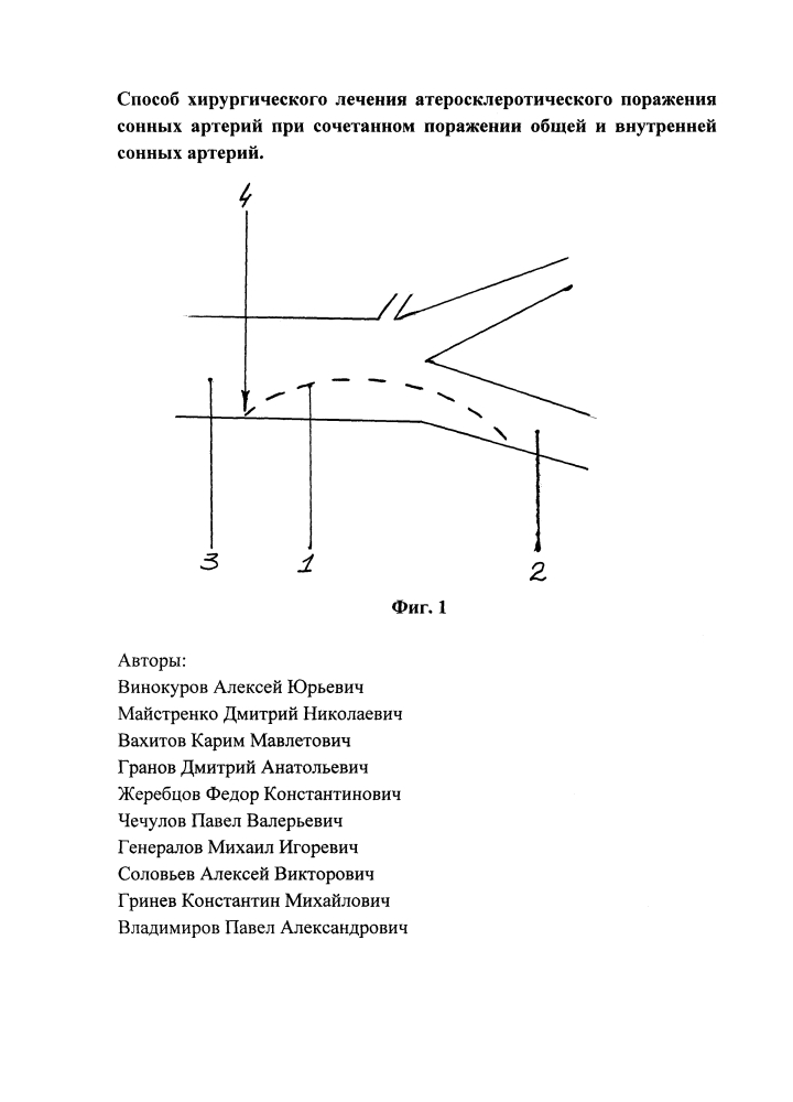 Способ хирургического лечения атеросклеротического поражения сонных артерий при сочетанном поражении общей и внутренней сонных артерий (патент 2623650)