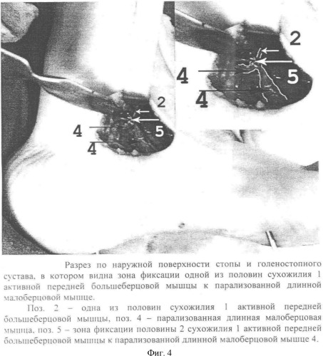 Способ устранения пяточно-варусной или пяточно-супинационной деформации стопы (патент 2361532)