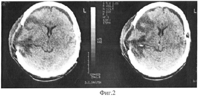 Способ лечения черепно-мозговой травмы (патент 2366466)