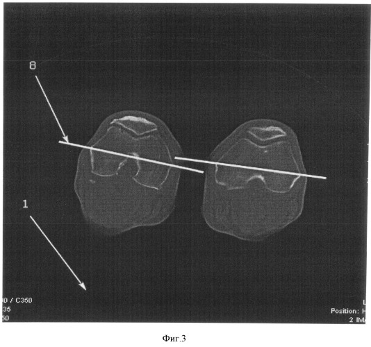 Способ оценки положения проксимального отдела бедренной кости (патент 2493774)