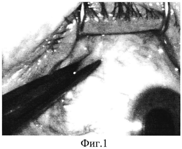 Способ интравитреального введения лекарственных препаратов в офтальмологии (патент 2581219)