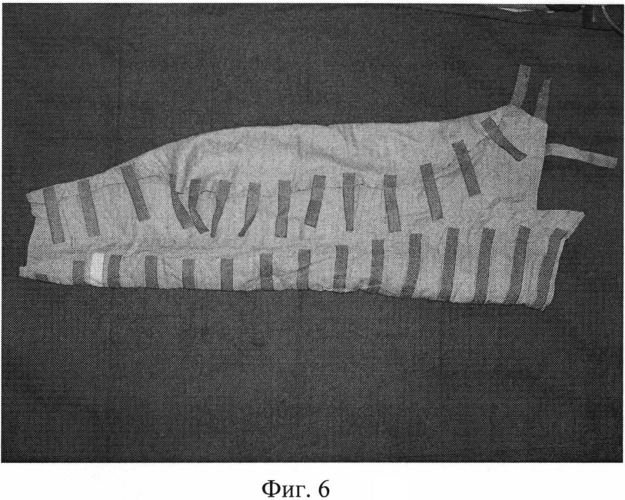 Способ лечения вторичных лимфедем нижних конечностей ii-iii стадии (патент 2570612)